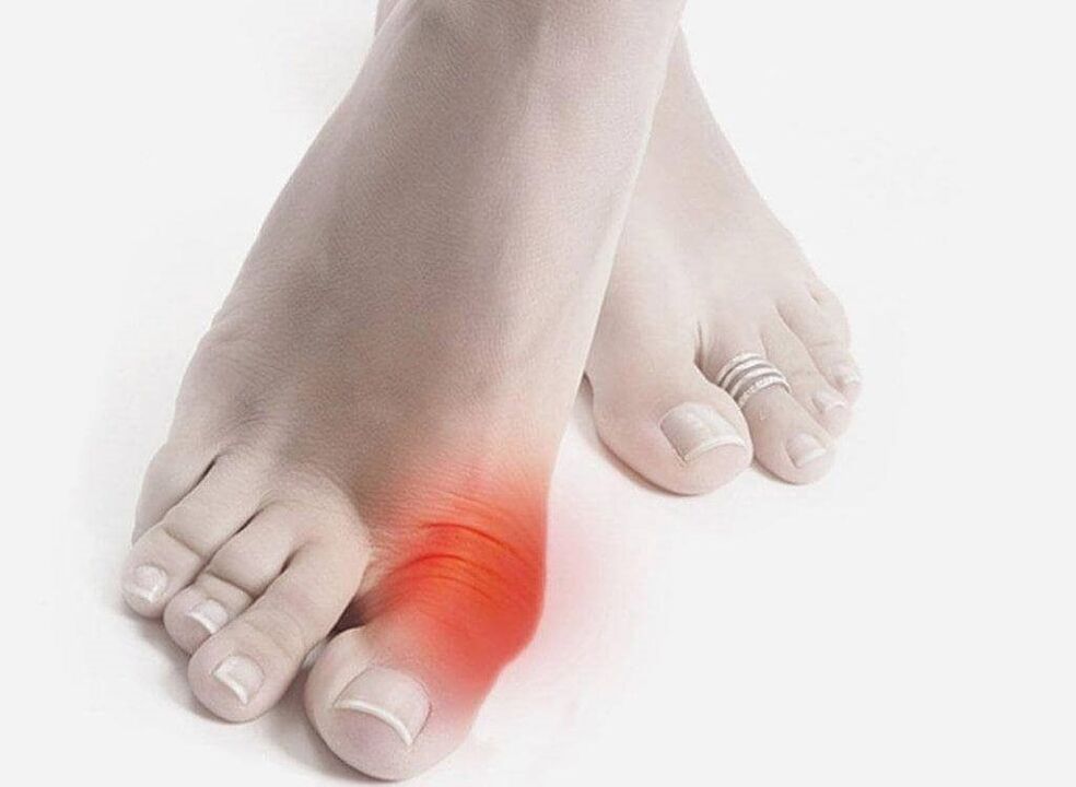 simptomi protina stopala